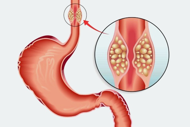 Medical illustration showing esophagus with tumor cells indicating need for esophageal cancer surgery