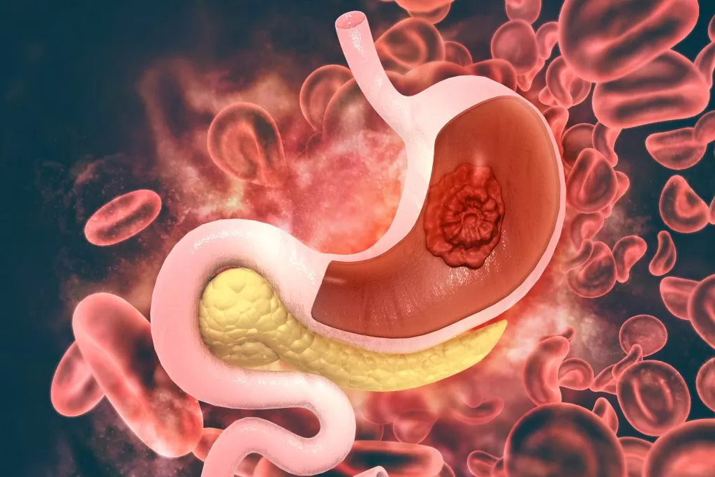 Medical illustration of stomach with tumor cells representing gastrointestinal cancer