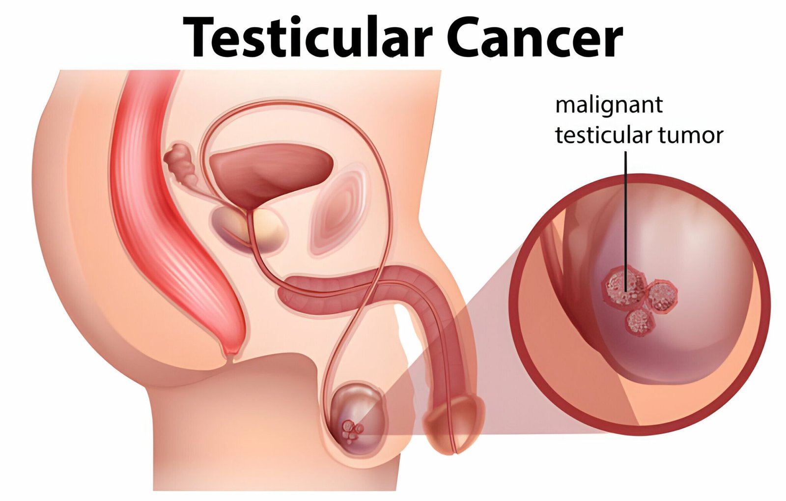 Testis Cancer Treatment in Ahmedabad